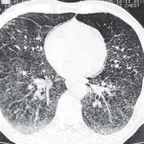 CT Thorax Lung Window Showing Diffuse Intra Alveolar Opacities Of