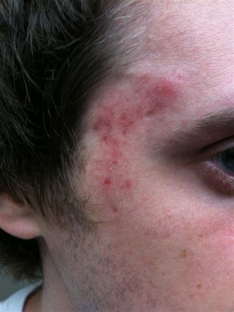 Help With Acne On Temples Picture General Acne Discussion