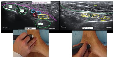 Jcm Free Full Text Ultrasound Guided Near Nerve Needle Sensory