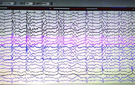 Electroencephalogram Showing Classical 1s Periodic Sharp Wave Complex