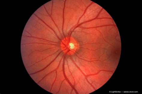 Glaucoma Mystery Focus On Deep Optic Nerve Structures Ophthalmology