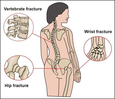 Another benefit of backbone is the ease of communicating with the server through ajax interactions. Spinal Osteoporosis,Spinal Osteoporosis Treatment,Osteoporosis India