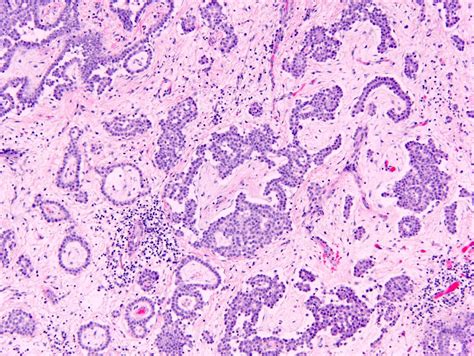 Multicystic Benign Mesothelioma Pathology Outlines Pathology Outlines
