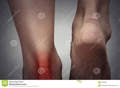 Painful Ankle With Red Spot On Woman S Foot Stock Photo Image Of