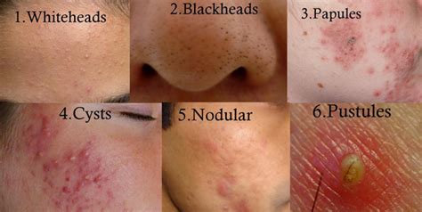 Pimple Popping Up Types Causes And Treatment For These Tender Bumps