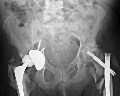 Survival Of Ceramic Bearings In Total Hip Replacement After High Energy