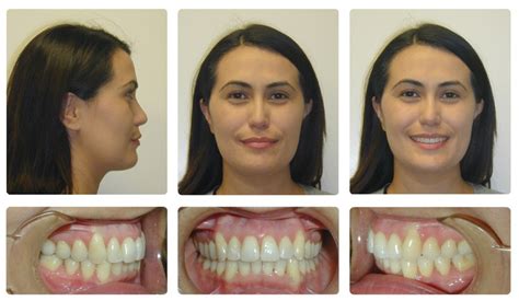 Invisalign Before And After Overjet