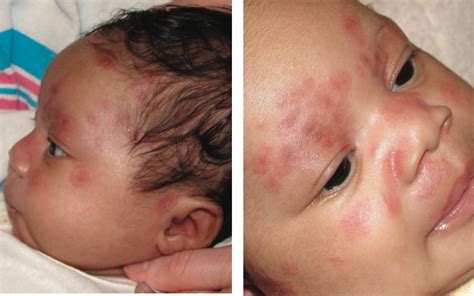 A Neonate With Skin Lesions Whats The Cause Consultant360