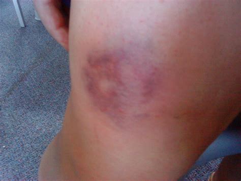 Leg Bruise Flickr Photo Sharing