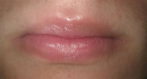 Most common causes of infection in inner or outer lips are fungal infection, iron deficiency, emotional stress. My progress so far (a long read) at Peeling Lips ...