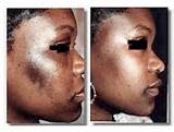 Laser Treatment For Acne Scars African American