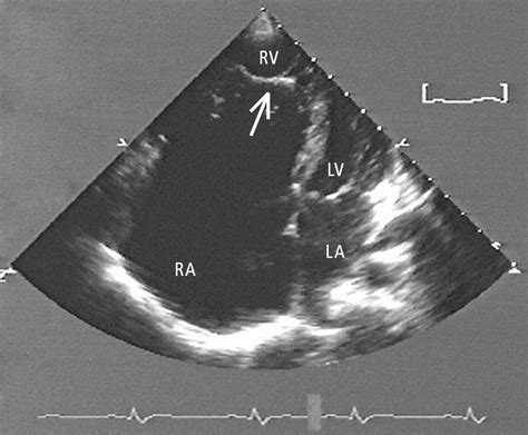 Ebstein Anomaly Congenital Heart Disease In Adults Cardiovascular