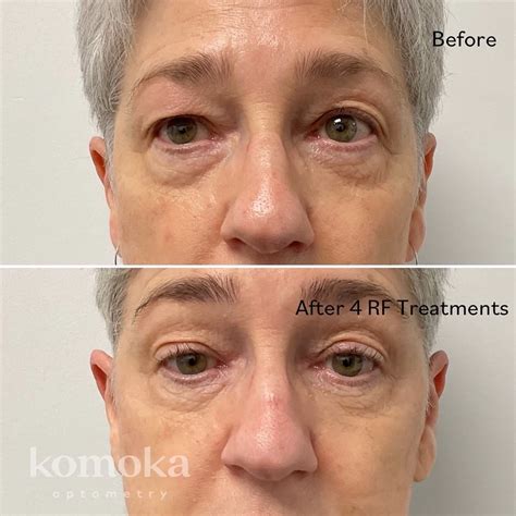 Dry Eye Treatment With Radiofrequency And Intense Pulse Light Komoka