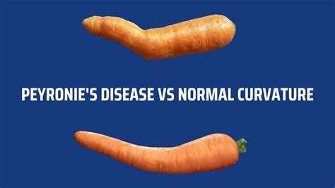 Peyronies Disease Vs Normal Curvature Heres What You Should Know