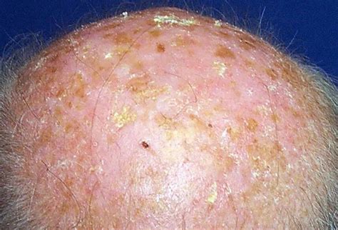 Solar Keratosis Picture Image On