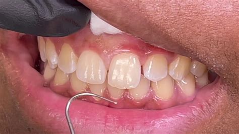 Houston Cosmetic Dentistuneven Gums When You Smile Simple Laser