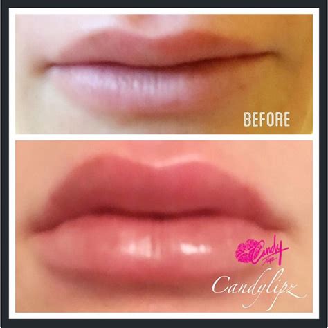 Most Outrageous Lip Plumping Tool Before And After Photos 6 Candylipz