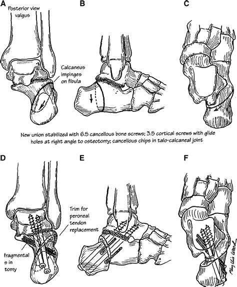 Calcaneus Malunion And Nonunion Foot And Ankle Clinics