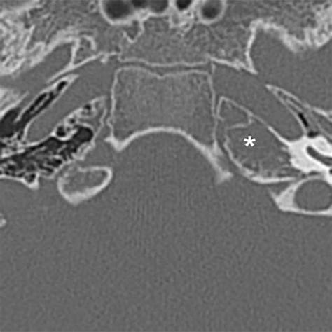 Ct Findings Consistent With Left Petrous Apex Opacification With