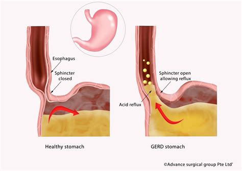 Gerd Causes Symptoms Treatment Signs Of Trouble
