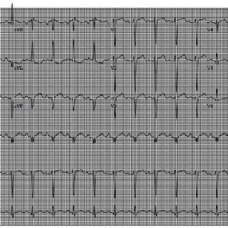 A 12 Lead EKG Demonstrating Sinus Tachycardia With Q Waves In Leads II