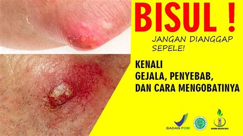 BISUL Jangan Dianggap Sepele Kenali GEJALA PENYEBAB DAN CARA