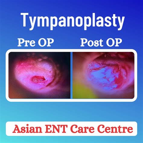 Best Micro Ear Surgery Centre In Hyderabad Best Tympanoplasty Doctor