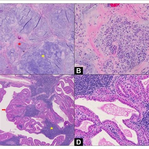 A Pleomorphic Adenoma Mixed Tumor Composed Of Mixed Components Of