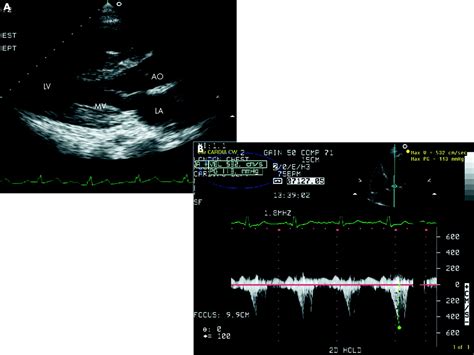 Alcohol Septal Ablation For Obstructive Hypertrophic Cardiomyopathy Heart