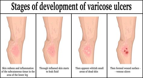 Venous Insufficiency Leg Ulcers Center For Advanced Cardiac And Vascular Interventions