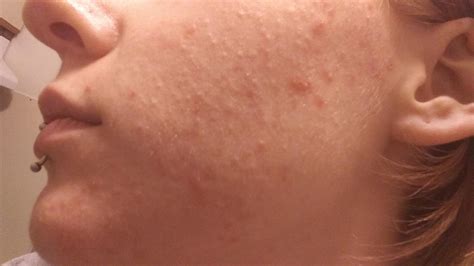 Here's how to know if you have it. Do I have Fungal Acne? Please help! : acne