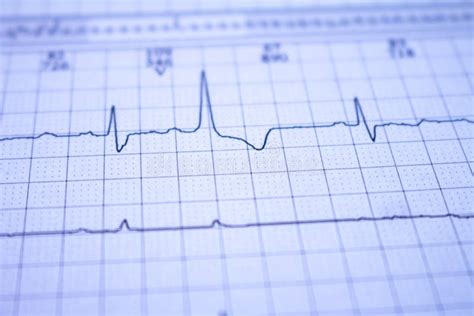 Close Up Of An Electrocardiogram With A Heartbeat Paper Representation