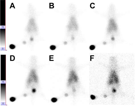 Dynamic Sentinel Lymphoscintigraphy At 30 Min 1 H 2 H 4 H 8 H And