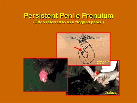 Persistent Penile Frenulum