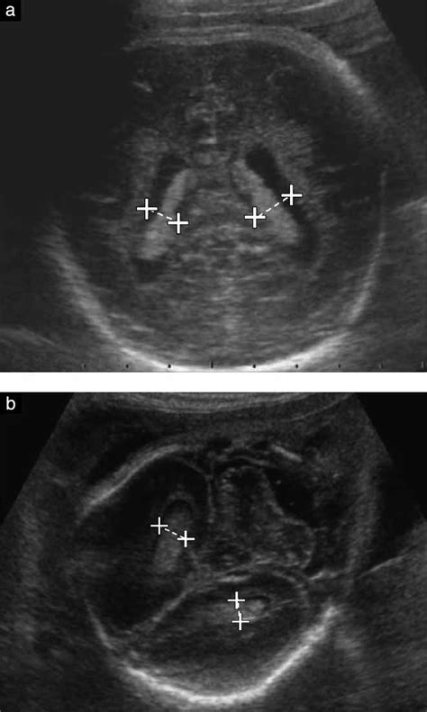 Coronal Measurement Of The Fetal Lateral Ventricles Comparison Between