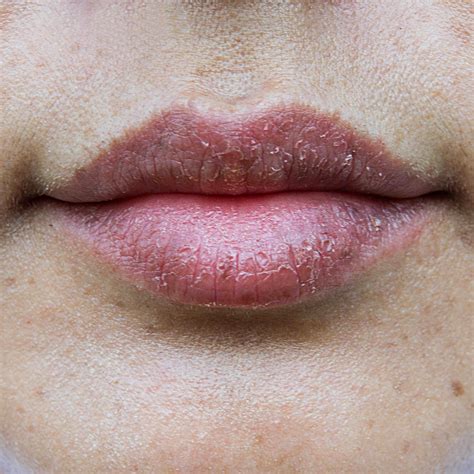 Cracked Lips Caused By Vitamin Deficiency Calcium Blog