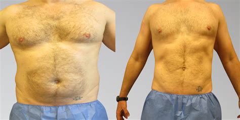 Male Liposuction Before Afters Sono Bello Results