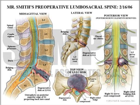 Lumbar Nerve Root Case Study Sanda Medical Graphics