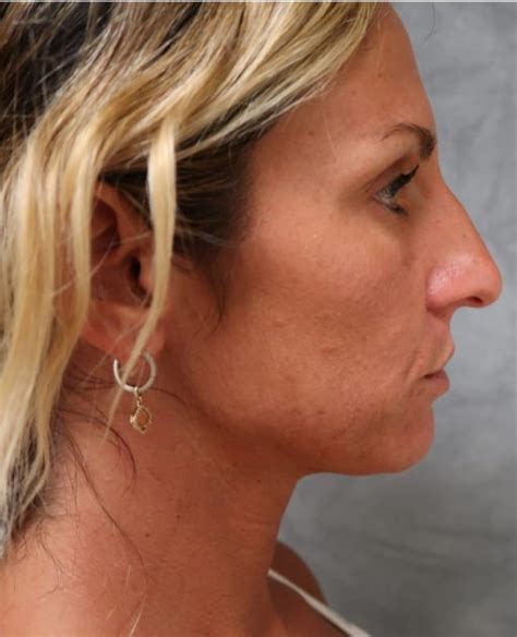 Rhinoplasty Richmond Virginia World Class Nose Job And Nasal Surgery