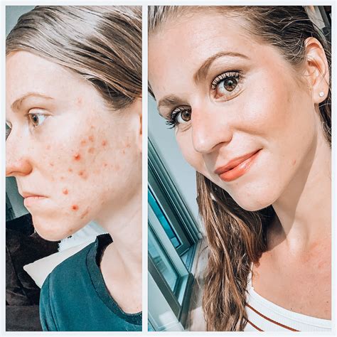 Hormonal Cystic Acne The Root Cause And 5 Steps To Treat It — Plant