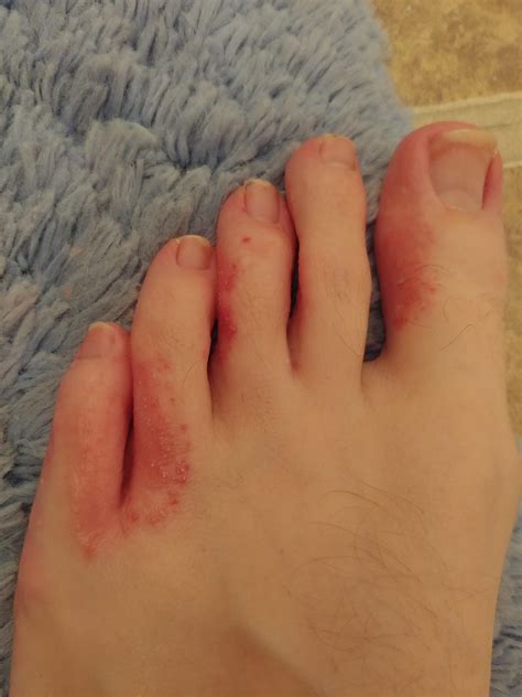 Ive Had This Rash Like Irritation On My Left Foot For A Couple Months