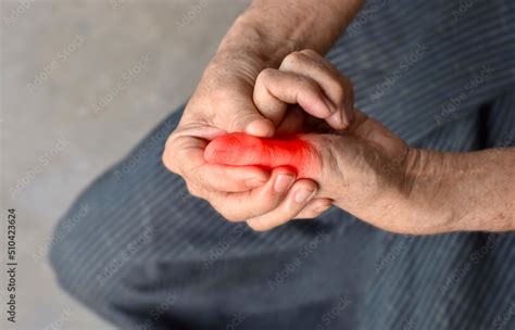 Inflammation Of Asian Man Thumb And Hand Concept Of Cellulitis And