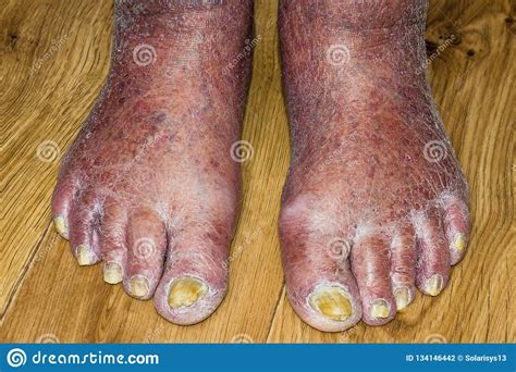 Fungus Infection On Nails Of Man`s Foot Stock Photo Image Of Damaged