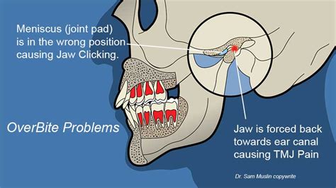 Neuromuscular Dentistry Vs Jawtrac Jaw Positioning