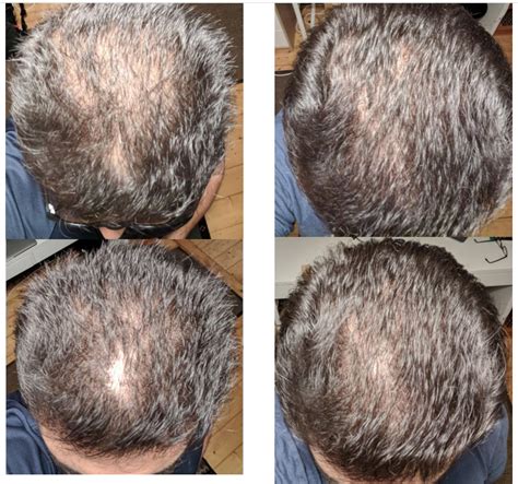 If the iron supplements don't. Morley Robbins - Regrow Your Hair Naturally