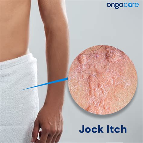Jock Itch Symptoms Causes Diagnosis Treatment