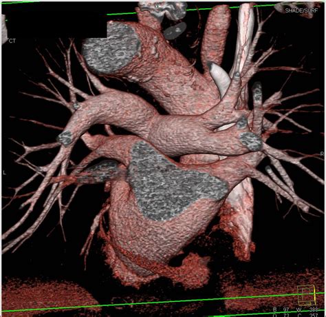 3d Mapping Of The Pulmonary Veins And Artery Cardiac Case Studies