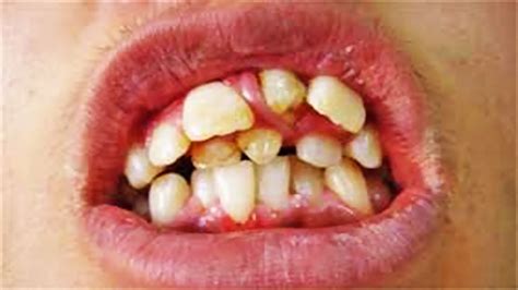 Why Do We Have So Many Teeth Teethwalls