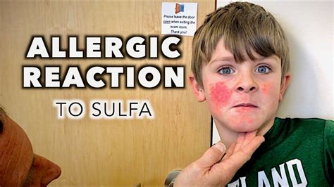 Allergic Reaction To Sulfa 9 Day Cellulitis Follow Up Dr Paul