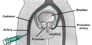 Prostate Artery Embolisation Pae Treatment At The Urology Partnership